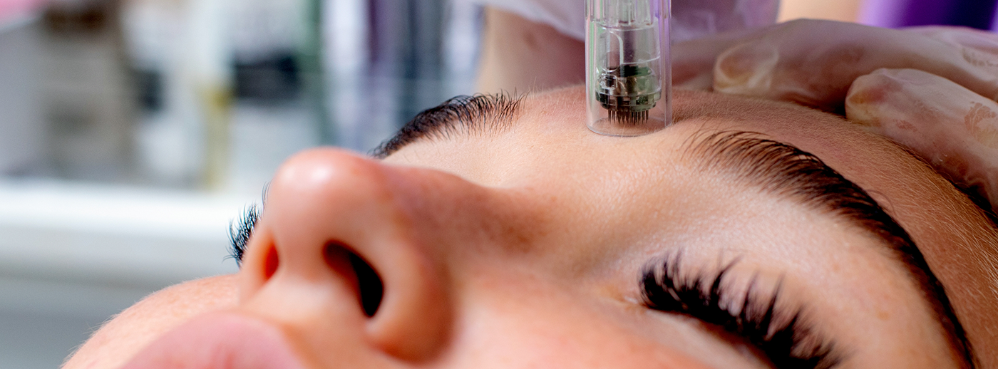 Woman receiving microneedling with PRP in forehead