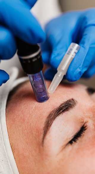 Microneedling with PRP in Sterling Heights