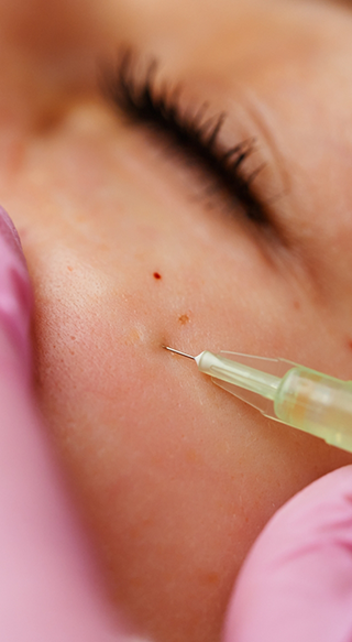 Close up of needle used for microneedling